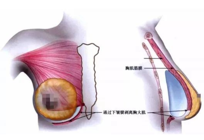 假體隆胸多少錢