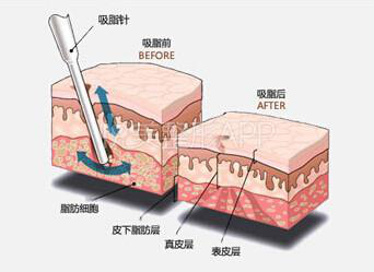 吸脂能(néng)不能(néng)瘦大腿？大腿吸脂有沒(méi)有風險？