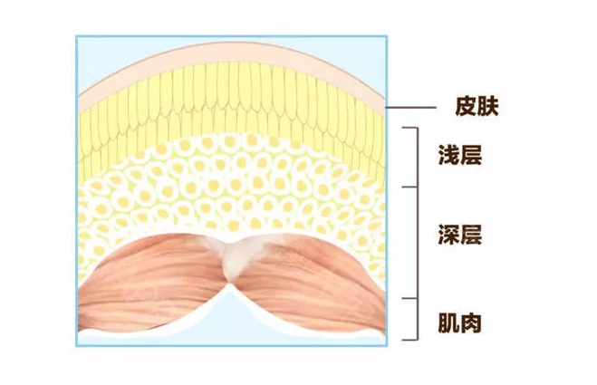 吸脂減肥