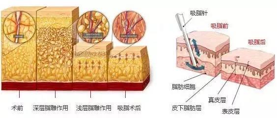 背部吸脂效果好(hǎo)嗎