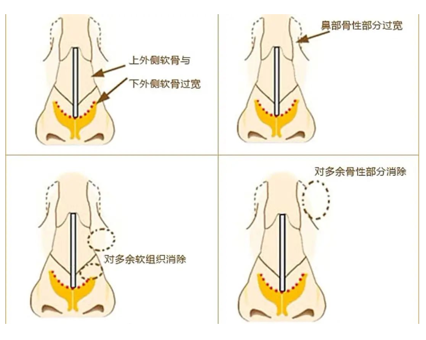 做隆鼻好(hǎo)嗎