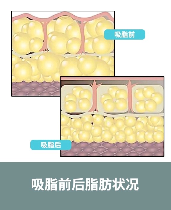 吸脂後(hòu)對(duì)比狀态