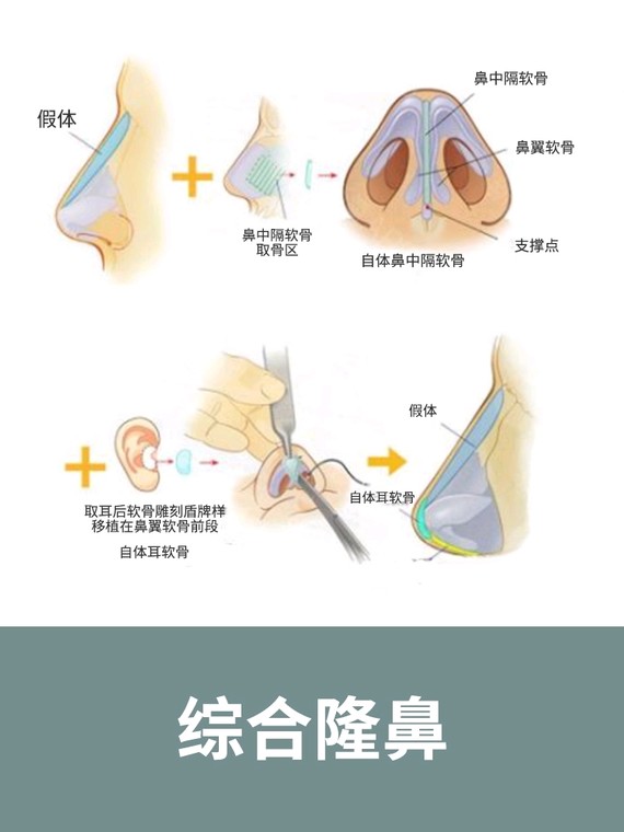 綜合隆鼻.jpg