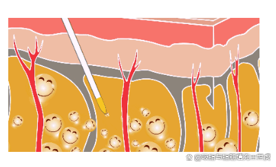 吸脂減肥醫院