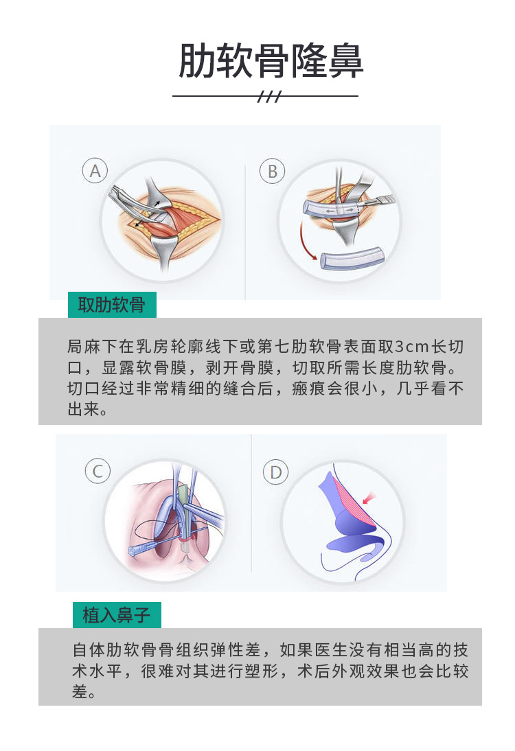 自體肋軟骨隆鼻價格