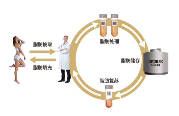 自體脂肪豐胸