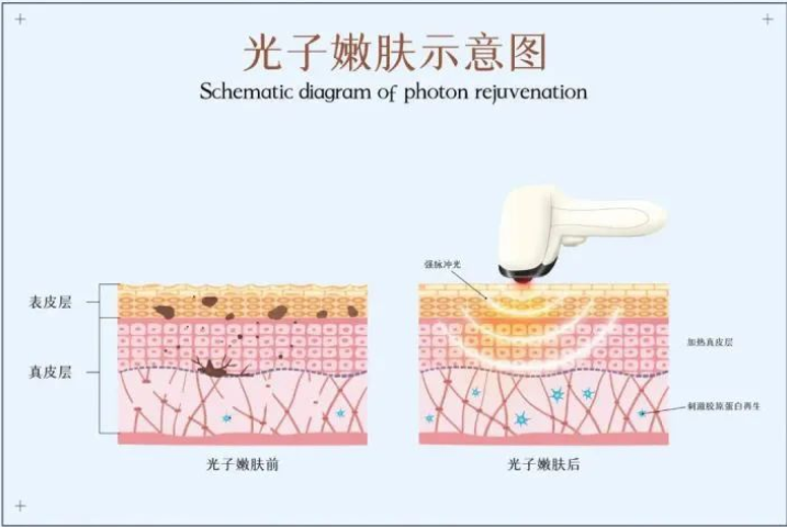 光子嫩膚的功效與作用