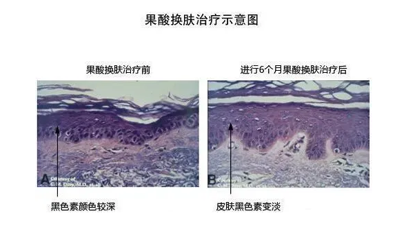 黃褐斑