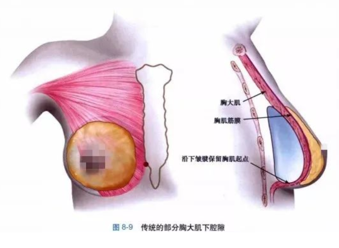 假體隆胸效果