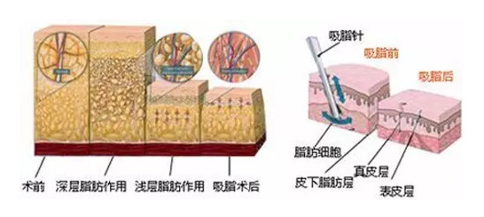 抽脂20斤