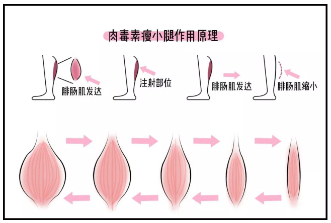 小腿粗怎麼(me)辦