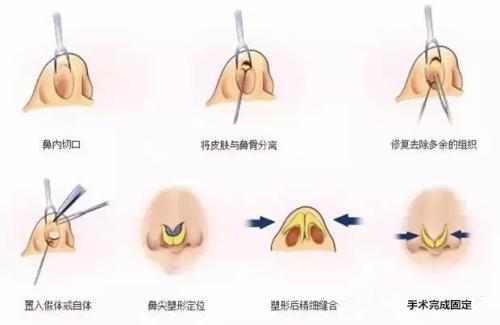 肋骨鼻可以維持終身嗎