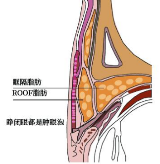 單眼皮怎麼(me)可以變雙眼皮