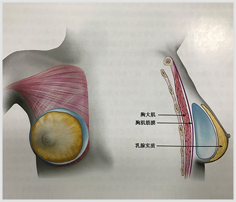 假體隆胸效果