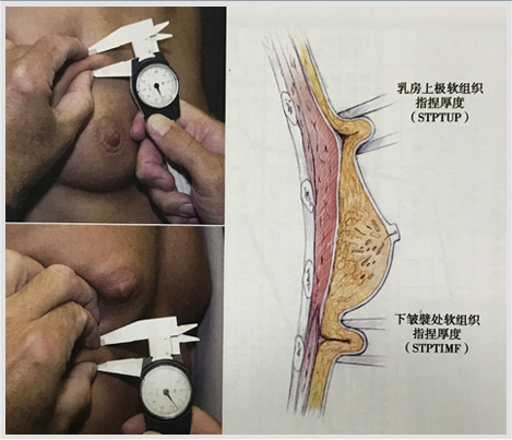 假體隆胸